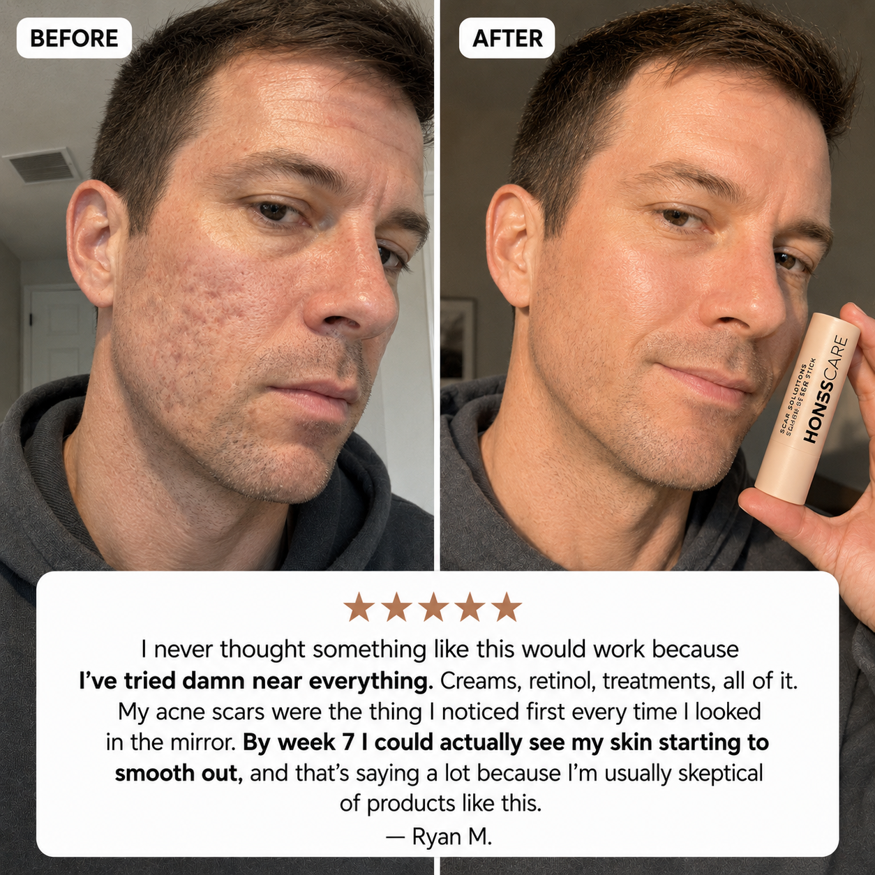 RejuvaSkin™ Acne Remodeling Stick