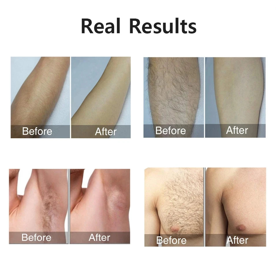 GlowPro™ IPL Laser Hair Removal Device